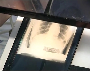 COPD: Az ötödik leggyakoribb halálok