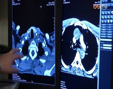 A stroke felismer�s�t seg�t� programot fogadott el a k�zgy�l�s