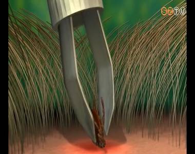 Elkezdődött a kullancsszezon Elkezdődött a kullancsszezon